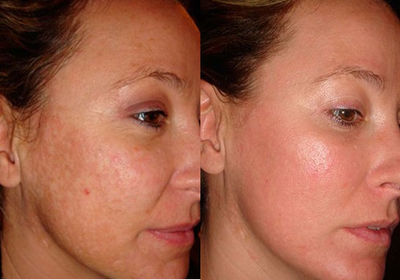 Fraxel Laser before and after photo