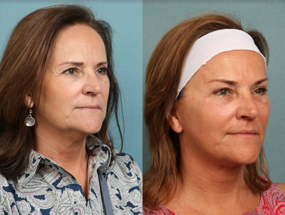 Lower Facelift before and after photo