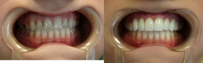 Porcelain Veneers before and after photo