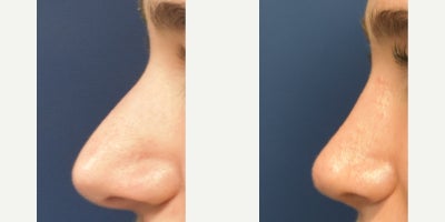 Revision Rhinoplasty before and after photo
