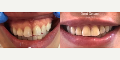 Smile Makeover before and after photo