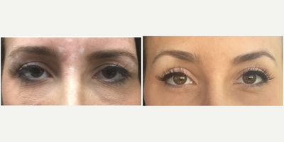 Botox before and after photo