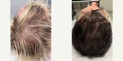 Hair Loss Treatment before and after photo