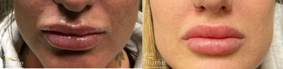 Lip Fillers before and after photo
