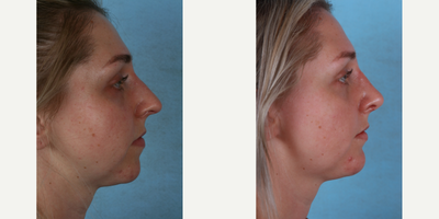 Rhinoplasty before and after photo