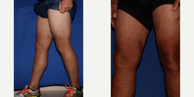 Sclerotherapy before and after photo
