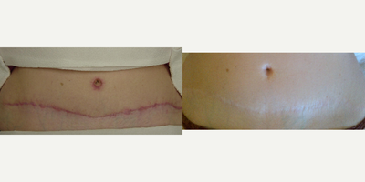Skin Rejuvenation before and after photo