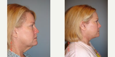 Facelift before and after photo