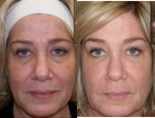 Fractional Laser before and after photo