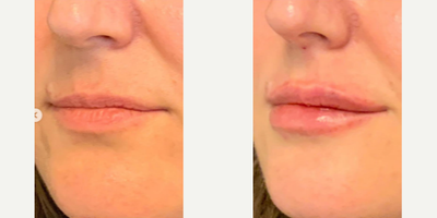 Juvederm before and after photo