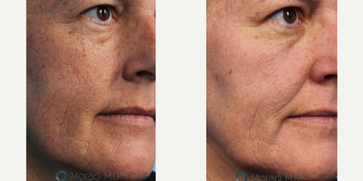 Laser Resurfacing before and after photo