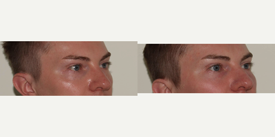 Volbella before and after photo