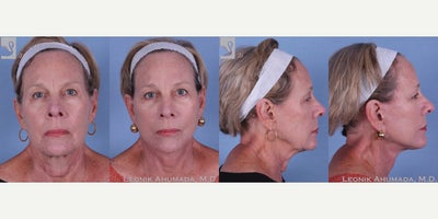 Facelift before and after photo