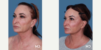 Facelift before and after photo