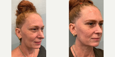 Juvederm before and after photo