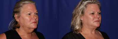 Kybella before and after photo