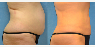 Liposuction before and after photo
