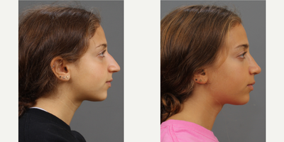 Rhinoplasty before and after photo
