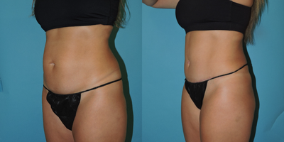 Tummy Tuck before and after photo