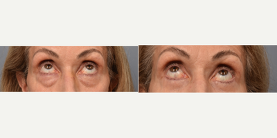 Eyelid Surgery before and after photo