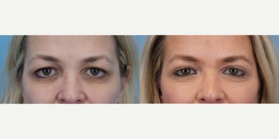 Eyelid Surgery before and after photo