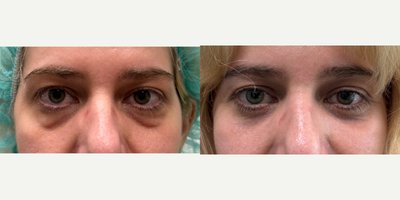 Eyelid Surgery before and after photo