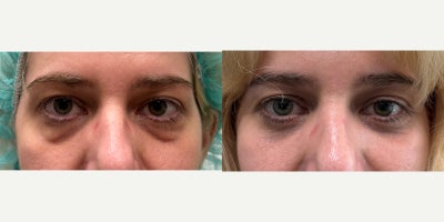 Eyelid Surgery before and after photo