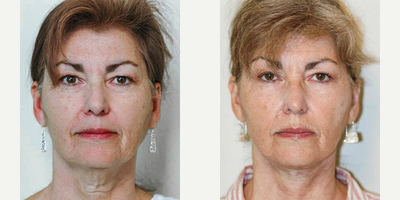 Facelift before and after photo