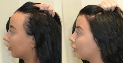 Forehead Reduction before and after photo