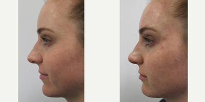 Nonsurgical Nose Job before and after photo