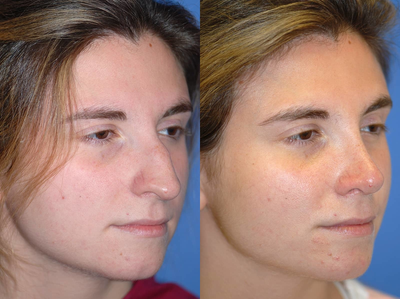 Asian Rhinoplasty before and after photo