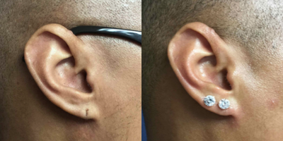 Earlobe Repair before and after photo