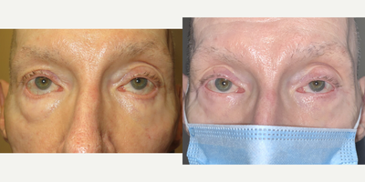 Eyelid Retraction Repair before and after photo