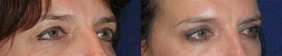 Eyelid Surgery before and after photo