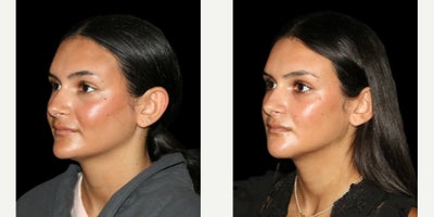 Genioplasty before and after photo