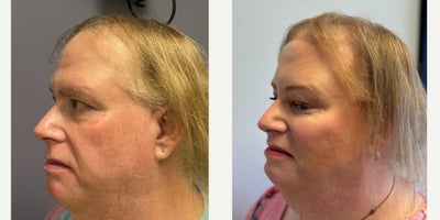 Lip Lift before and after photo