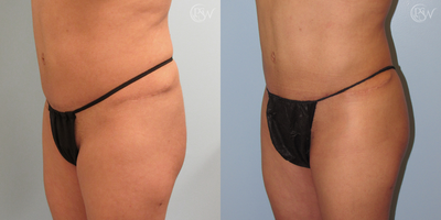 Liposuction before and after photo