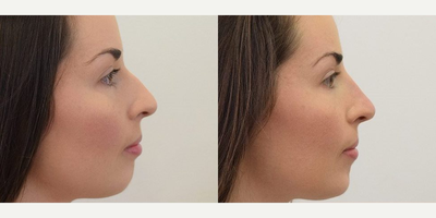 Nonsurgical Nose Job before and after photo