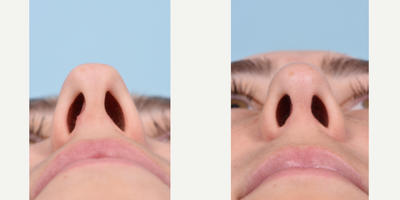 Rhinoplasty before and after photo