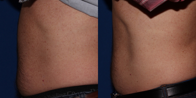 Vanquish before and after photo