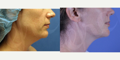 Chin Liposuction before and after photo