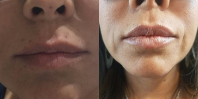 Juvederm before and after photo