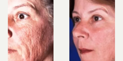 Laser Resurfacing before and after photo