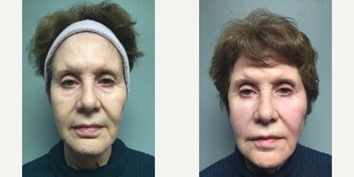 Bellafill before and after photo