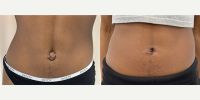 Belly Button Surgery before and after photo