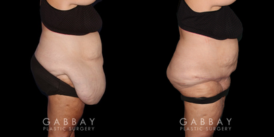Body Lift before and after photo