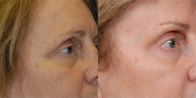 Botox before and after photo