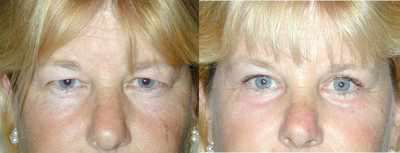 Brow Lift before and after photo
