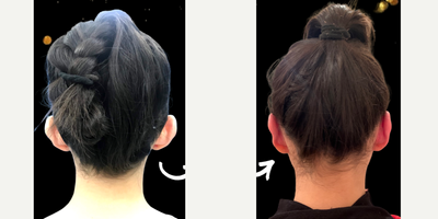 Ear Surgery before and after photo