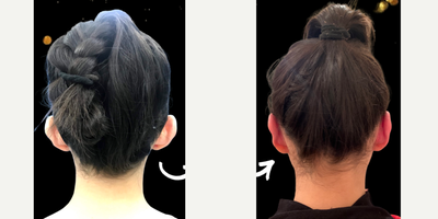 Ear Surgery before and after photo